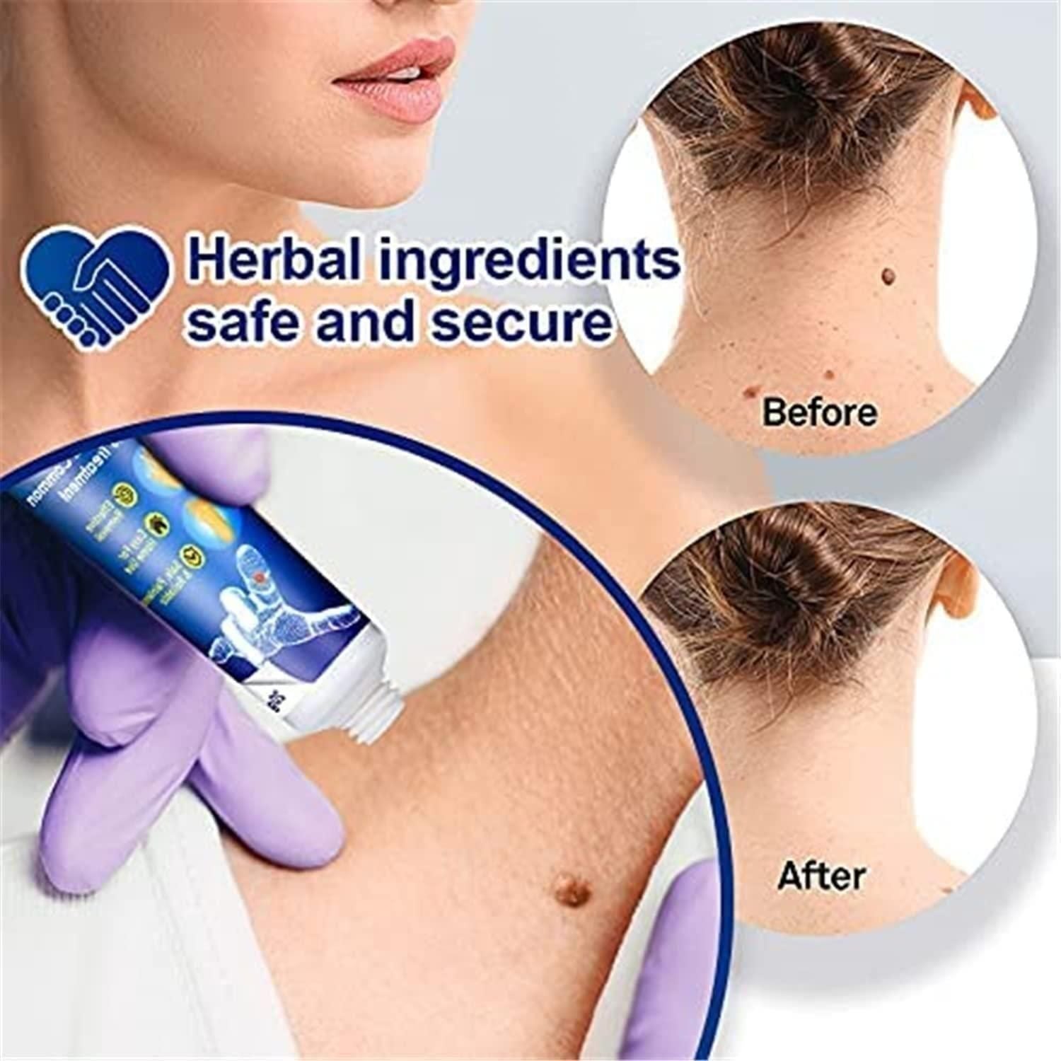 Atemporal Warts Remover Cream - AmazingBaba