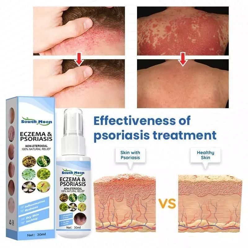 Herbal Psoriasis Relief Spray - AmazingBaba